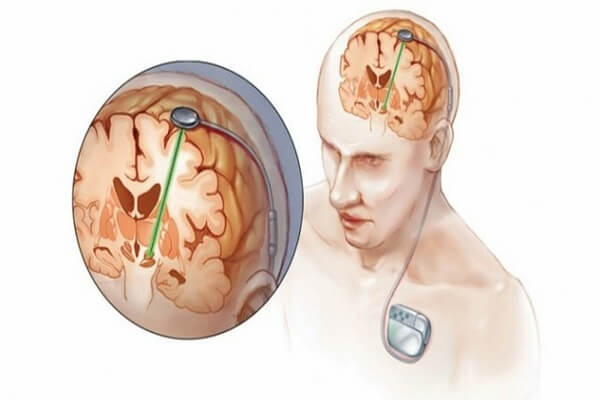 Deep Brain Stimulation